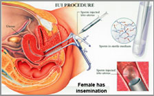 IUI Hospital,IUI Treatment,IUI Clinic,IUI Cost,IUI Center Jalandhar